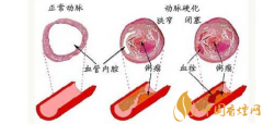 吸煙對血管的危害大嗎 五大吸煙對血管壁的危害